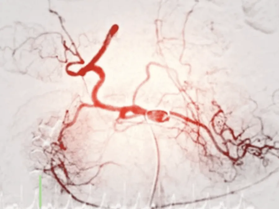 Sistema Endovascular